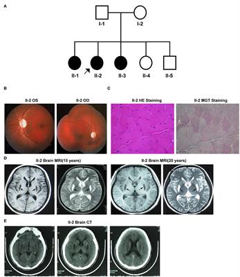 A Novel Variation in the Mitochondrial Complex I Assembly Factor NDUFAF5 Causes Isolated Bilateral Striatal Necrosis in Childhood